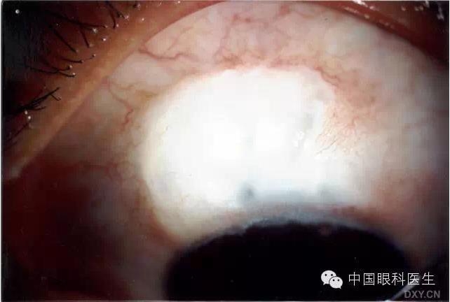 ������˹�����̬�ּ�����׼��Ƭ