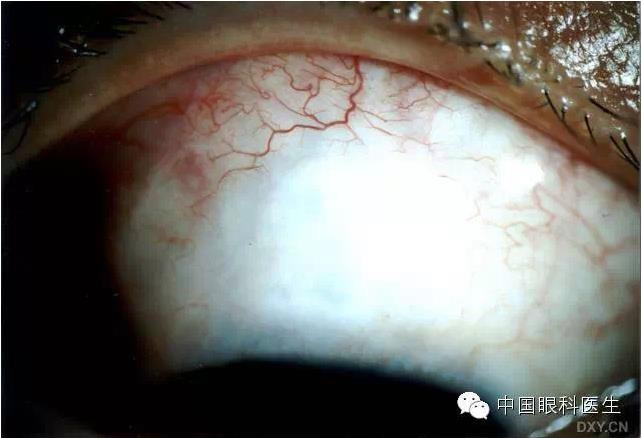 ������˹�����̬�ּ�����׼��Ƭ