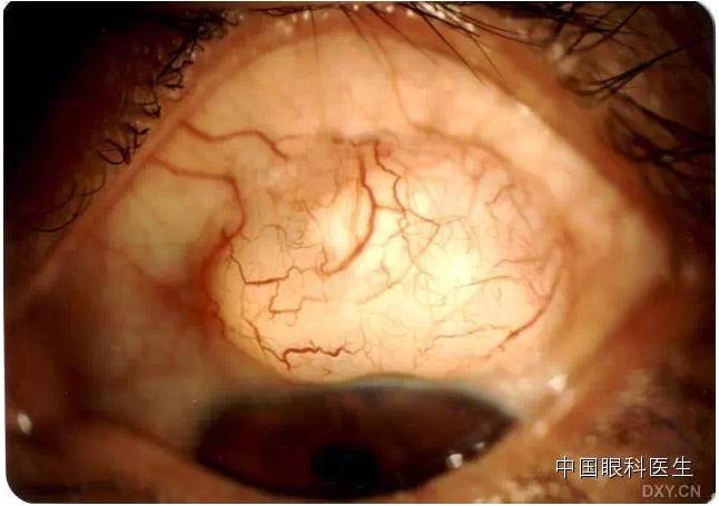 ������˹�����̬�ּ�����׼��Ƭ