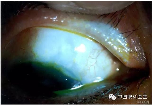 ������˹�����̬�ּ�����׼��Ƭ