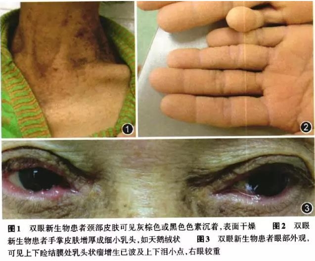 ���������ڼ�Ƥ���½�Ĥ��ͷ״�����ı�һ��