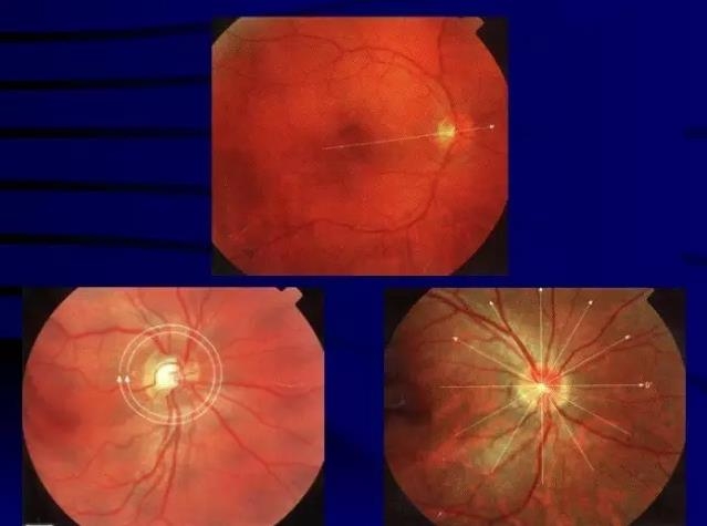 OCT���ۿ��ٴ�����е�Ӧ��