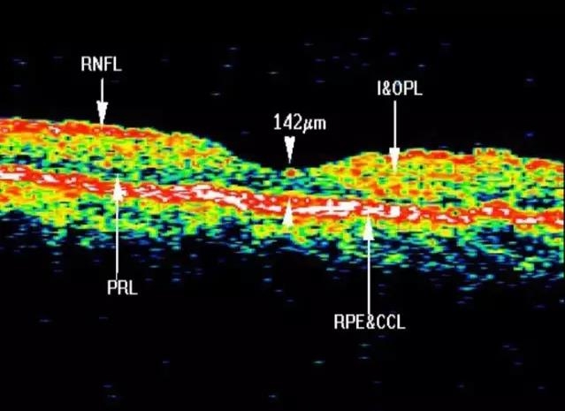 OCT���ۿ��ٴ�����е�Ӧ��