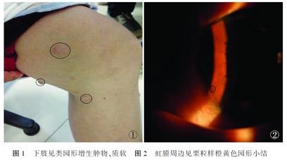 ��������I������ά�����۲�Lisch���1��