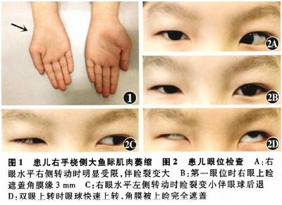 ��������Duane������ۺ�����Chiari-I�ͻ���һ��