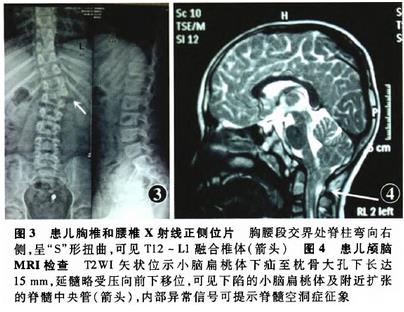 ��������Duane������ۺ�����Chiari-I�ͻ���һ��