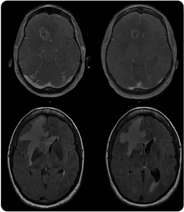 ��������TREX1 ����ͻ�������������ĤѪ�ܲ��� 1 ��