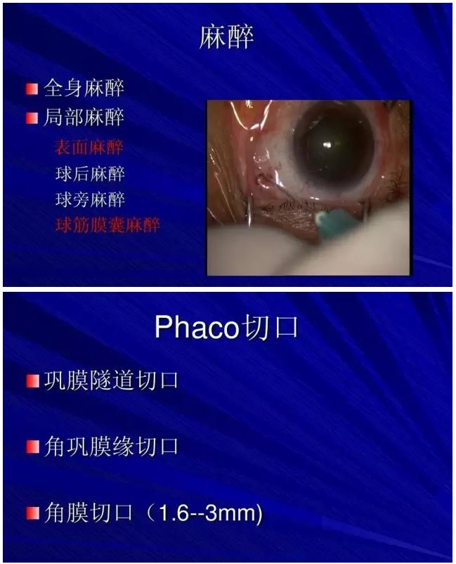 Phaco������������