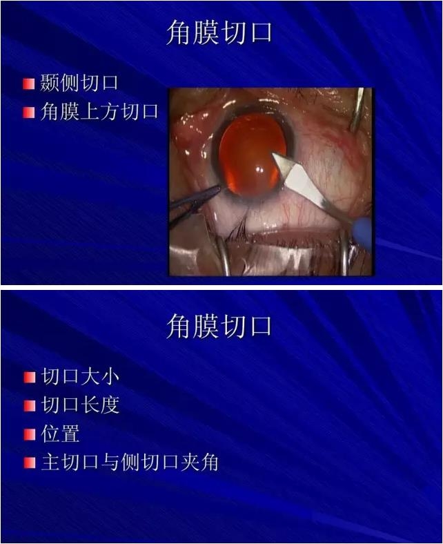 Phaco������������