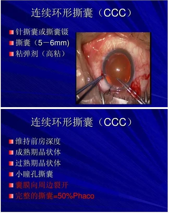 Phaco������������