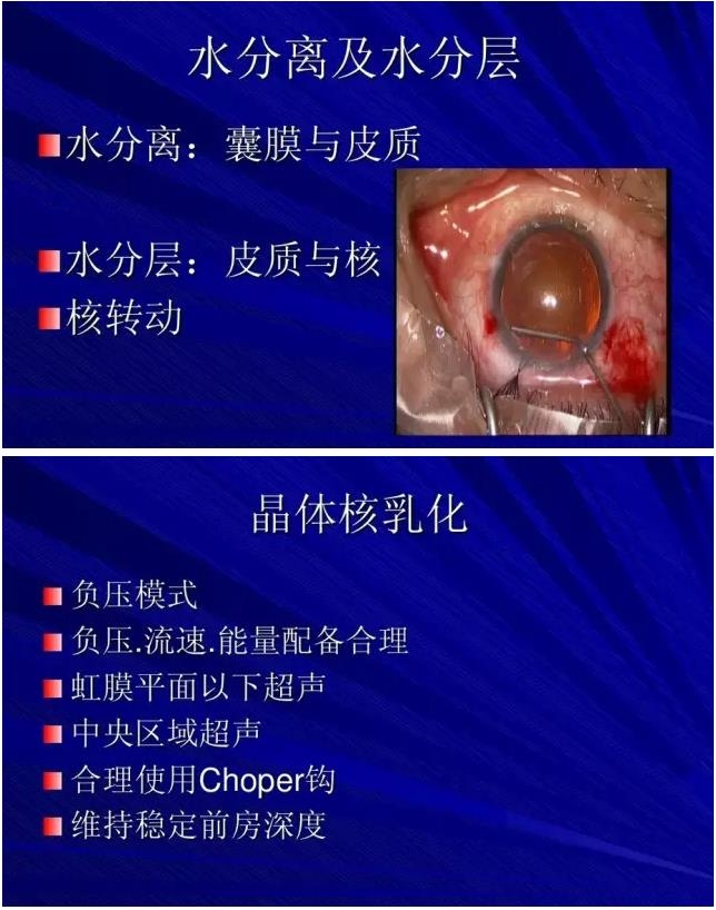 Phaco������������