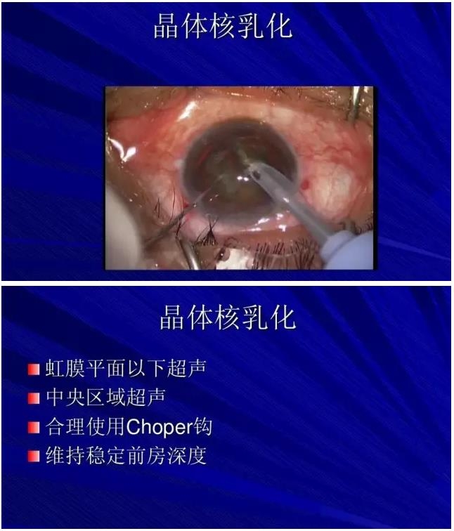 Phaco������������