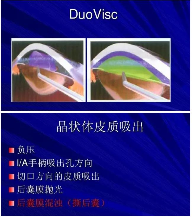 Phaco������������