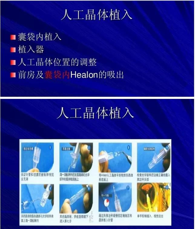 Phaco������������