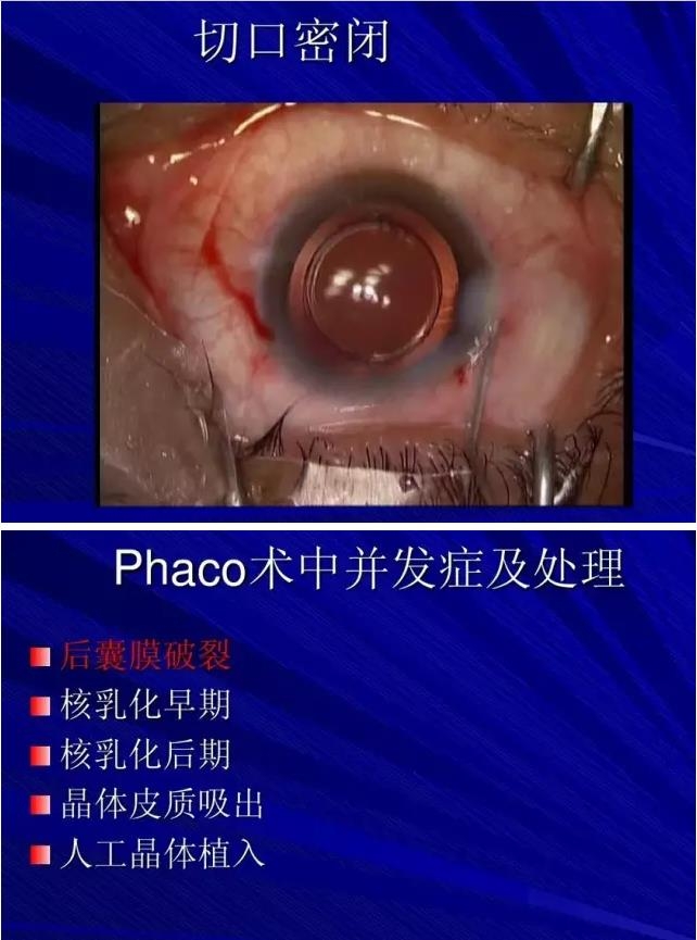 Phaco������������