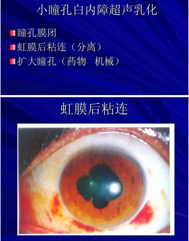 Phaco������������