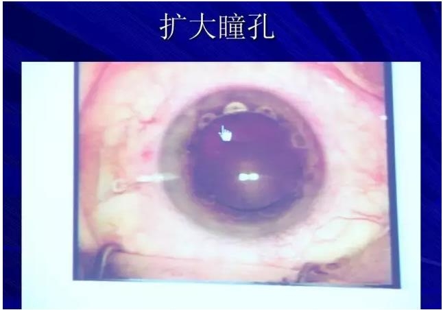 Phaco������������