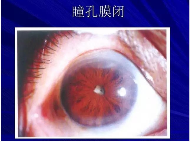 Phaco������������