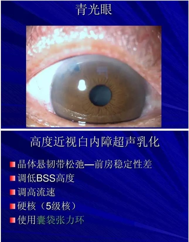 Phaco������������