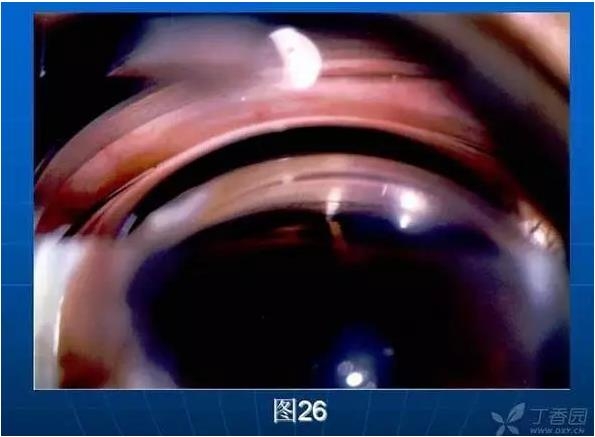 ǰ���Ǿ����Ĳ�������