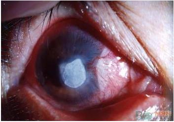 �ۿ���ҩ�ٵݣ�ŷ����ʽ�����׸���Ӫ���Խ�Ĥ������ҩ��Oxervate (rhNGF������������������)