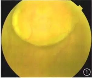 ��������������Ĥƽ������һ��