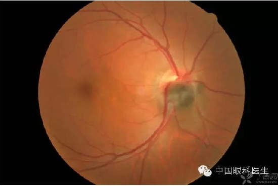 ��ͬ�۲��ĸ����۵�Ƭ