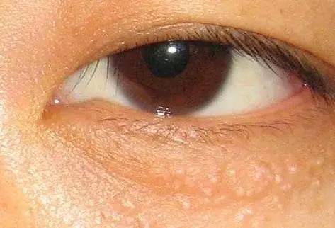 眼周的那些小颗粒到底是些啥?
