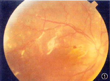 玻璃体视网膜显微手术治疗晚期coats病三例