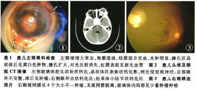 儿童眼睛母细胞瘤图片图片