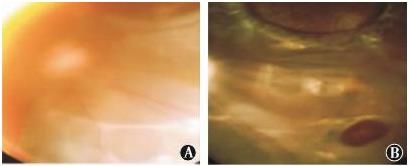 ������������Ĥ��Ƥ׼���Ӽ��������Խ�Ĥ���������ƶ�ͯ��Ĥ��״����һ��