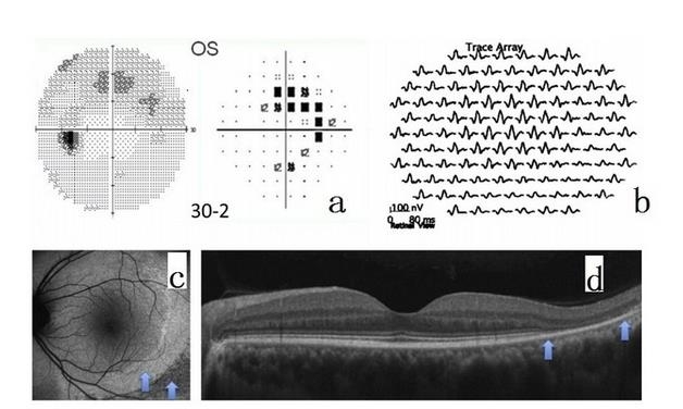 视网膜oct的详细图解图片